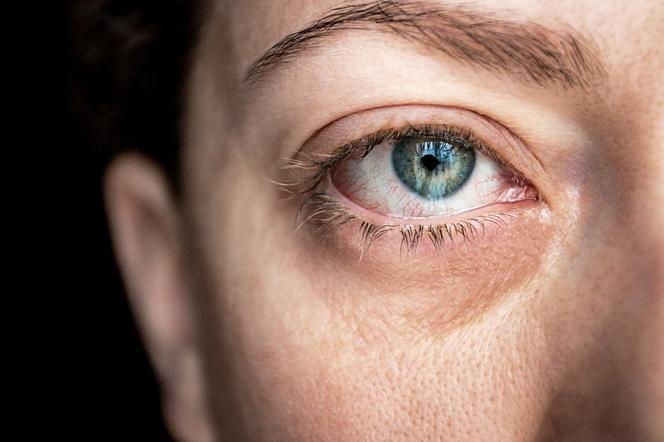 Łzawienie oczu: przyczyny. Jakie choroby objawiają się łzawieniem?